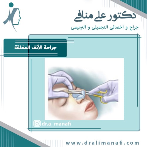 جراحة الأنف المغلقة