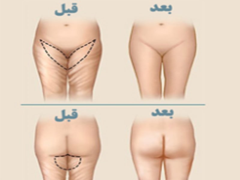 جراحة البلاستیکیة شد الفخذ او تابیلاستی